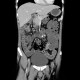 Mesenterium commune, gut malrotation, Crohn's disease of terminal ileum: CT - Computed tomography